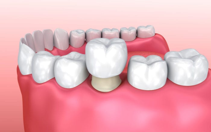 Tooth Crowns in Garland, TX