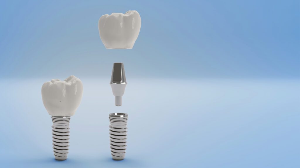 Dental Implants in Garland, TX