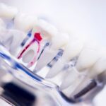 The Anatomy of a Root Canal